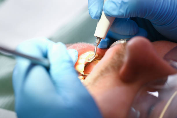 Best Emergency Treatment for Dental Infections or Abscesses in Crozet, VA